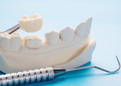 Crowns & Bridges: Reliable Solutions for Damaged Teeth
