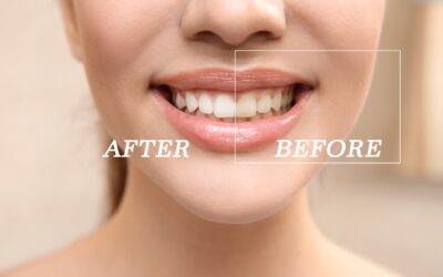 Teeth Whitening: Professional Results That Last
