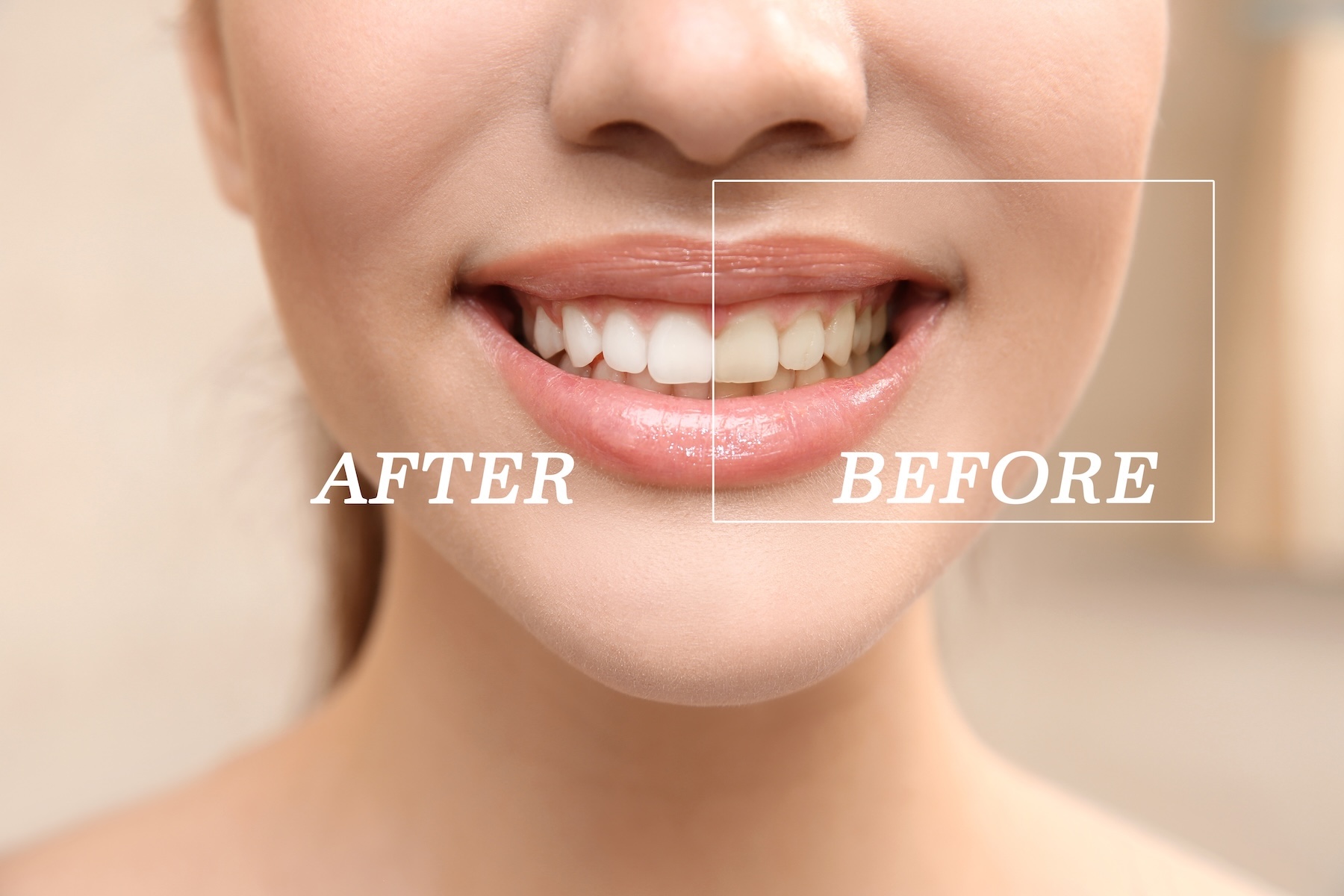 Teeth Whitening: Professional Results That Last