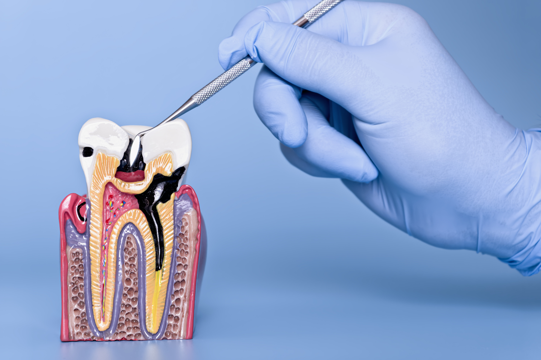 Cavity Treatment in Norwell: Early Signs, Prevention, and Simple Solutions