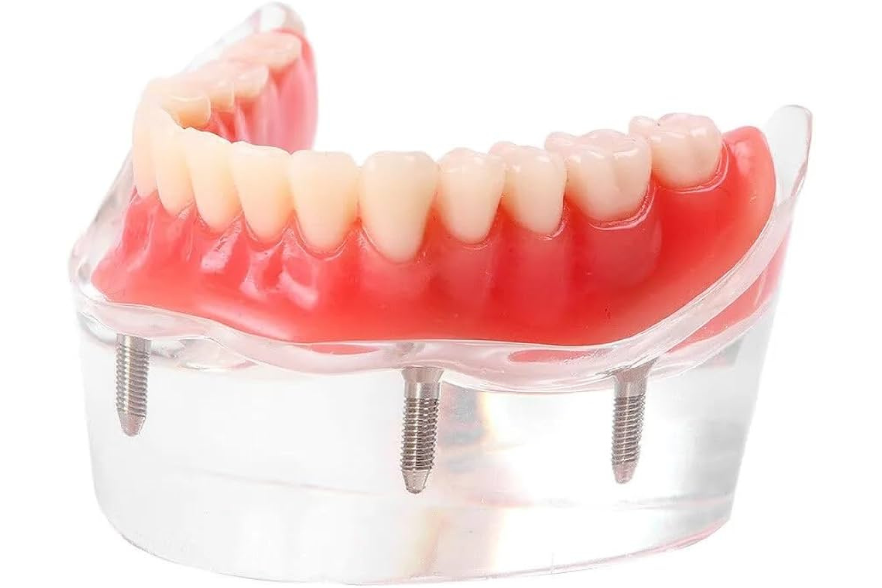 Dentures vs. Implant Dentures: Which Option Is Right for You?