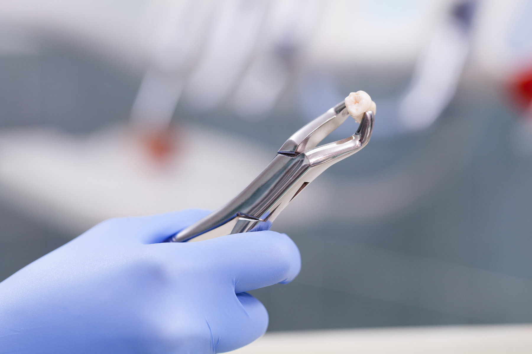 Tooth Extractions in Norwell: When Removal Is the Best Choice
